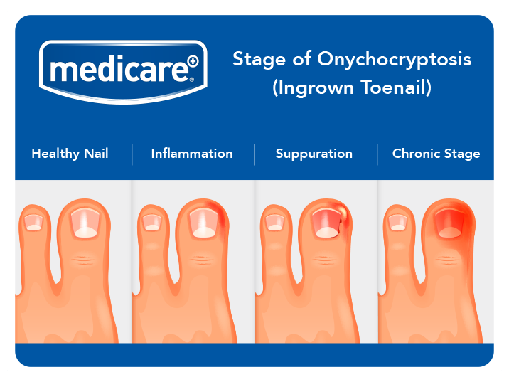 What to do if you suffer from an ingrown toenail? - Footcare Scotland