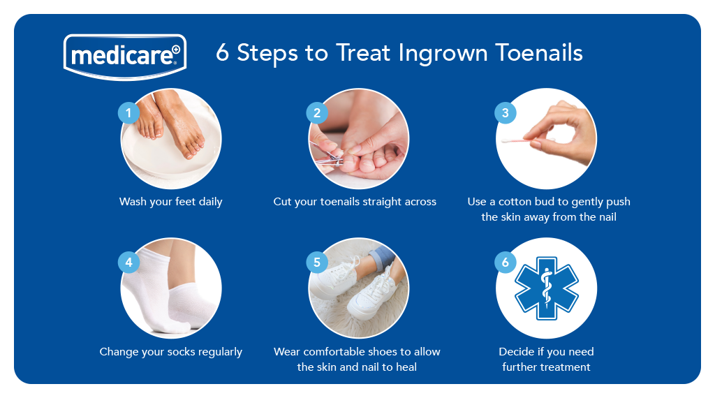 How You Can Stop Foot and Toenail Fungus In Its Tracks – Cleveland Clinic