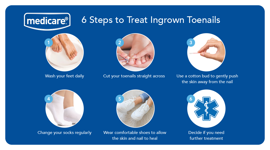 How To Prevent And Treat Your Baby's Ingrown Toenails - MVS