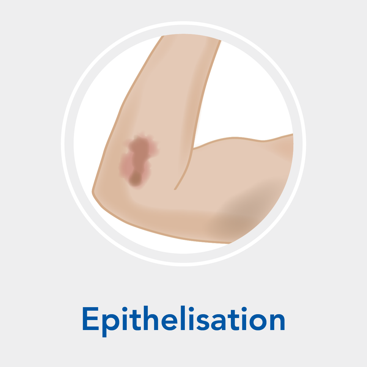 Stage 4: Epithelisation